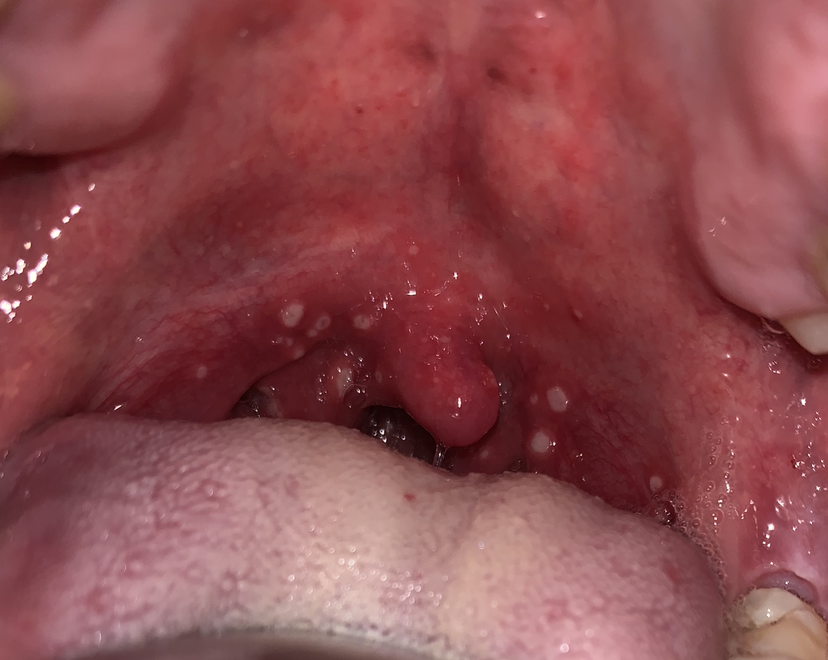 慎入 扁桃腺發炎好撚痛啊 Lihkg 討論區