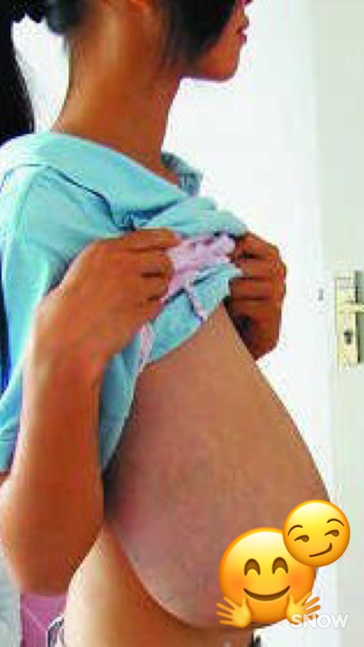 巨乳症 